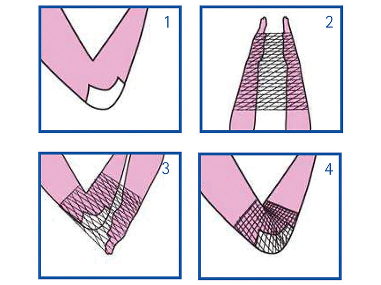 Surgifix® Elastiskt rörformigt nät - Hand/Armbåge/Arm - 10 st/förpackning