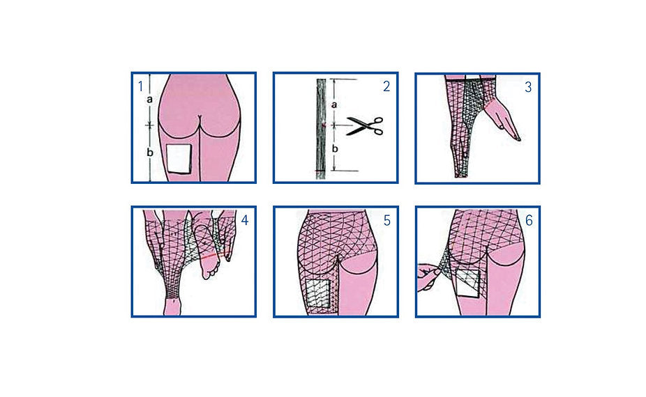 Surgifix® Elastiskt rörformigt nät - Kropp/Bäcken/Lår - 5 st/förpackning